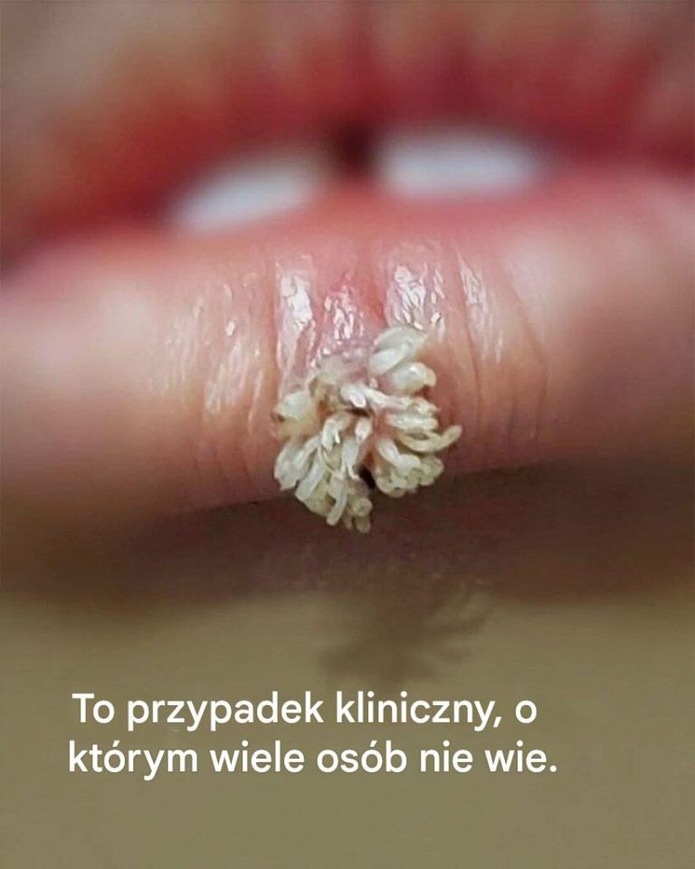 Czy masz nieoczekiwany wyprysk? Twoja bariera skórna może być uszkodzona.